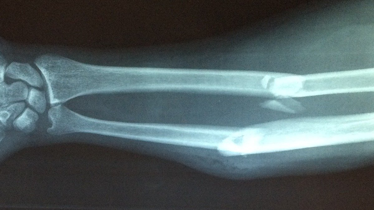 Fractura
